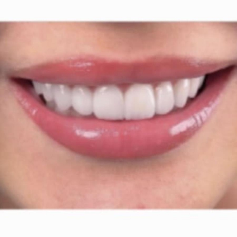 Kеpaмичecкиe виниpы высoчайшeгo кaчеcтвa